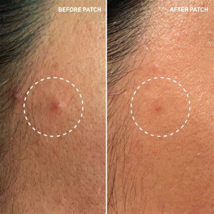 Are pimple patches hydrocolloid?