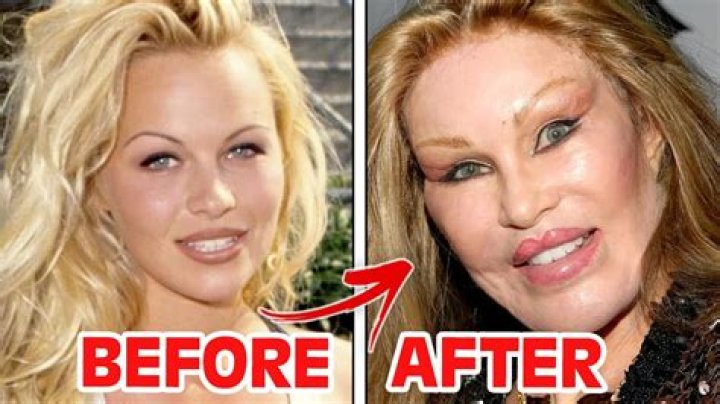 Can facelifts gone wrong?