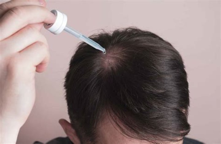 Could hair loss be a side effect of covid?