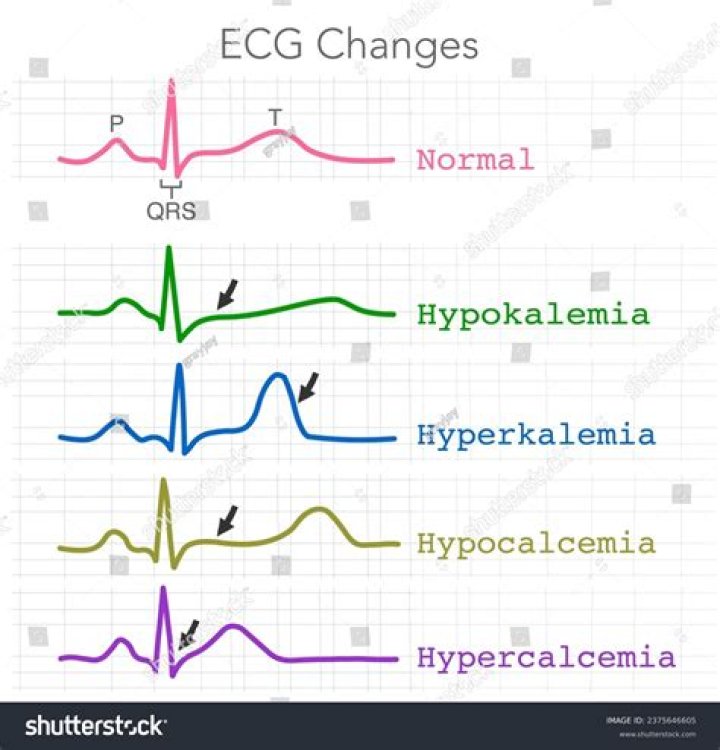 Does hypercalcemia increase heart rate?