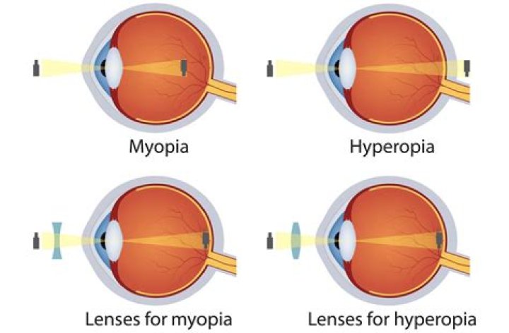 Does hyperopia get worse?