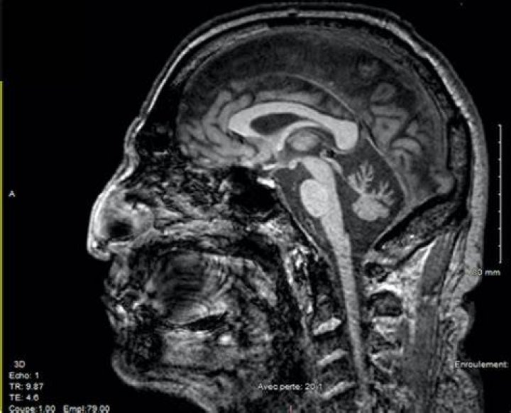 How is spinocerebellar ataxia diagnosed?