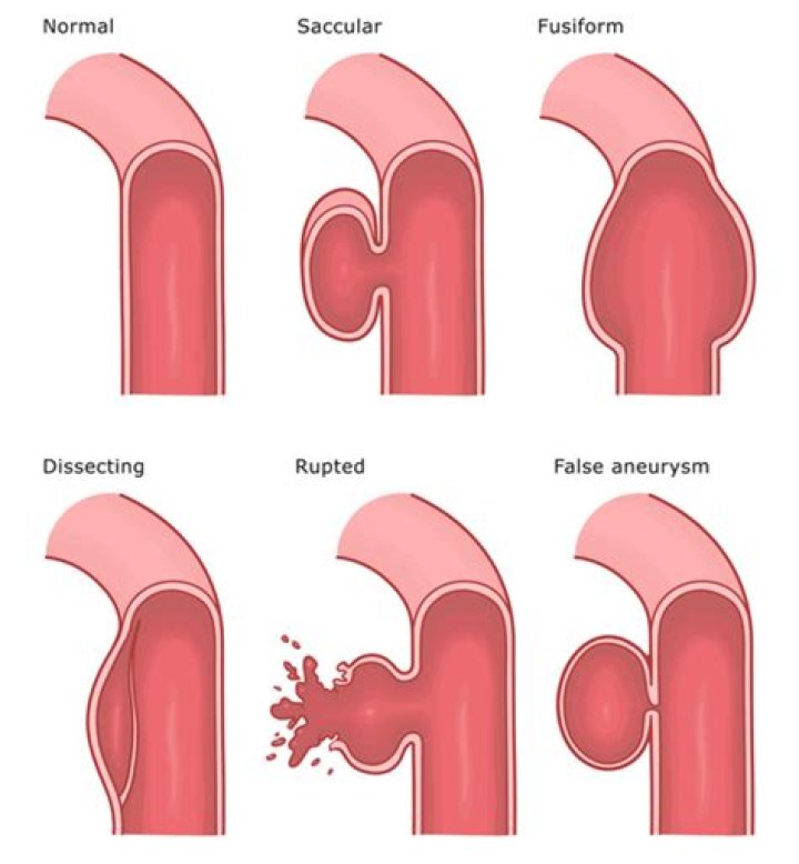 Is fusiform aneurysm dangerous?