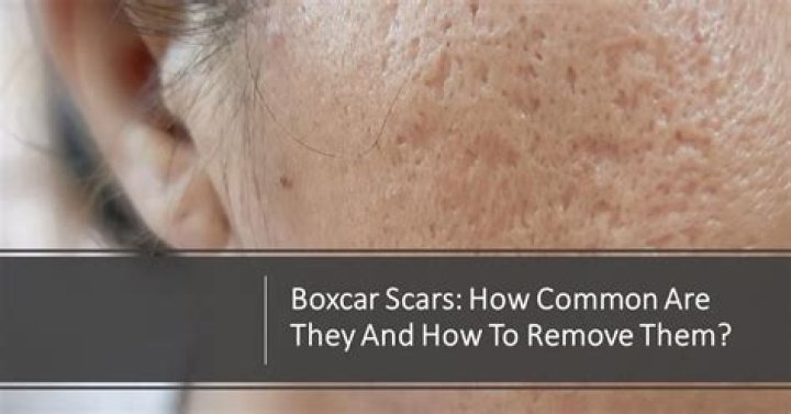 What are boxcar scars?
