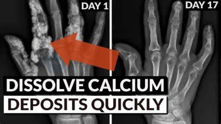 What dissolves calcium deposits in the body?
