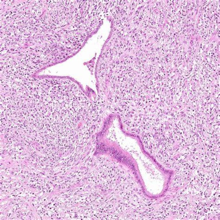 What is adenosarcoma pathology?