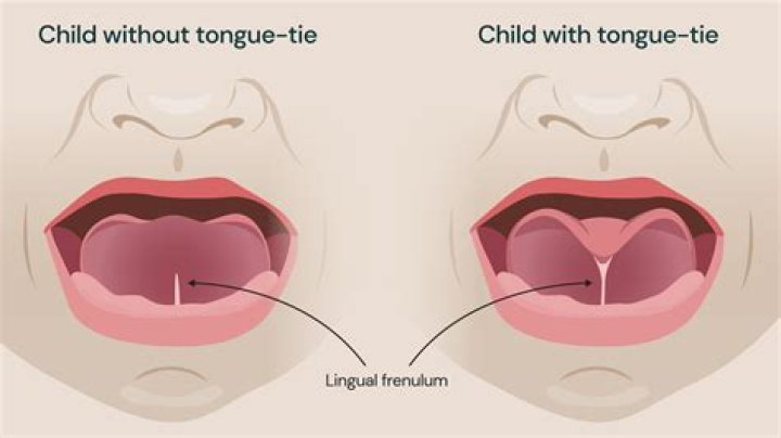Why am i always tongue tied?
