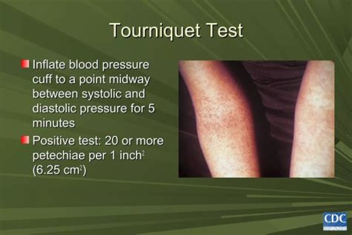 Why tourniquet test is done?